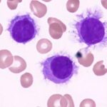 hairy cell leukemia