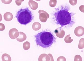 hairy cell leukemia