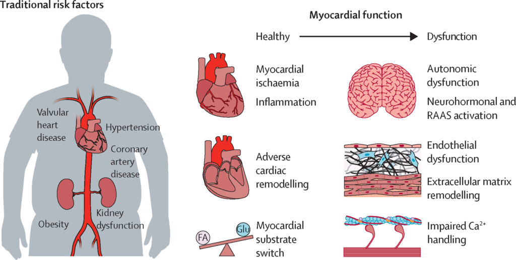 heart failure associated with type 2 diabetes mellitus