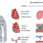 heart failure associated with type 2 diabetes mellitus