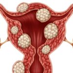 heavy menstrual bleeding associated with uterine leiomyoma