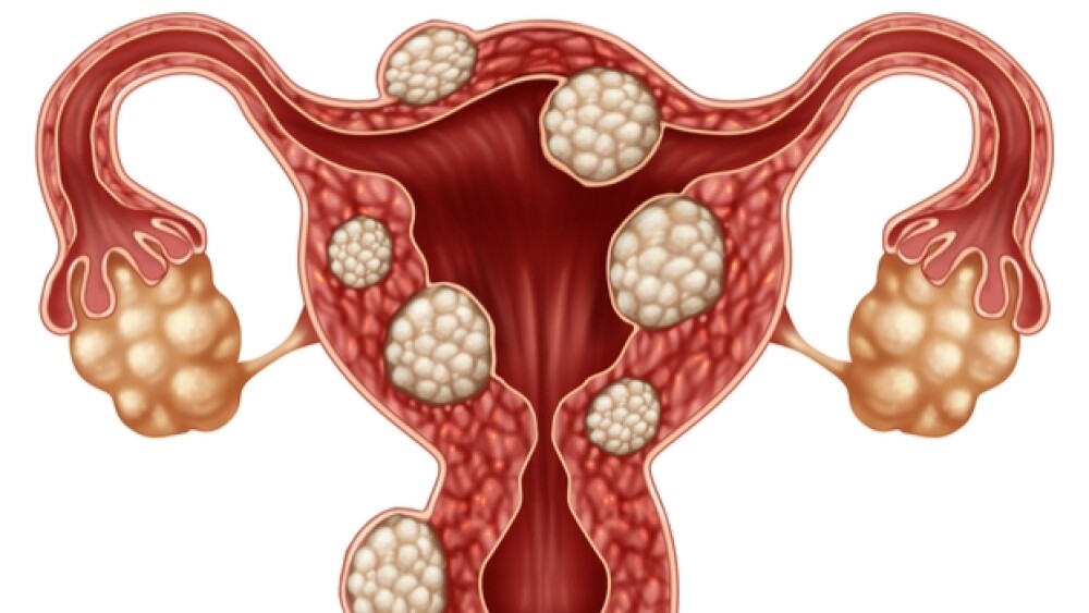 heavy menstrual bleeding associated with uterine leiomyoma