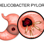 helicobacter pylori gastritis