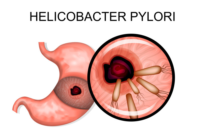 helicobacter pylori gastritis