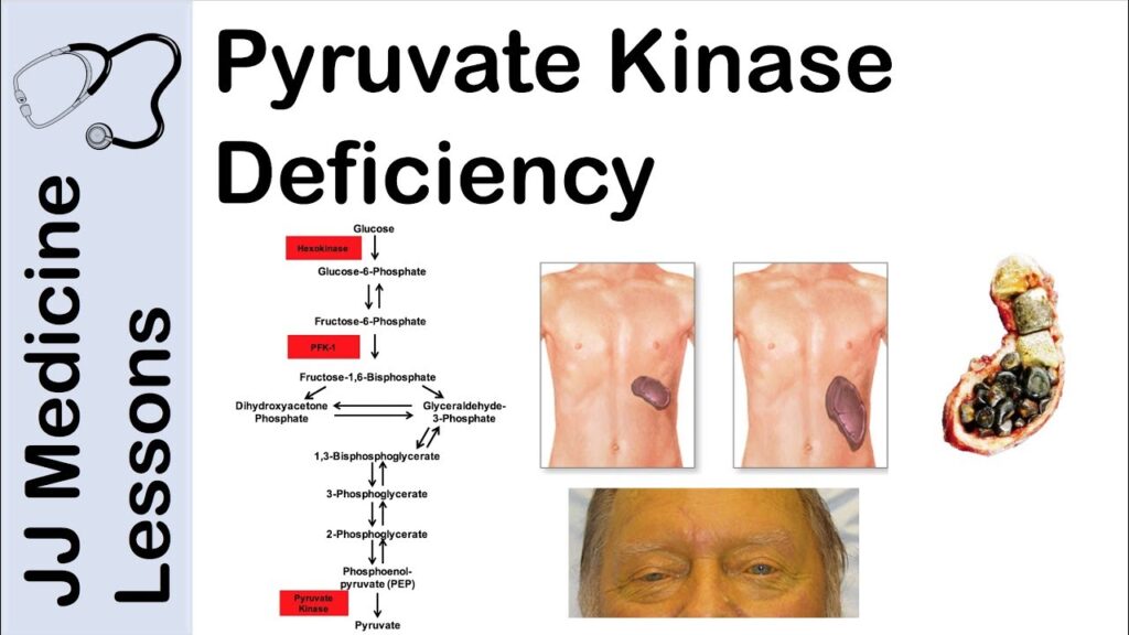 hemolytic anemia due to pyruvate kinase deficiency