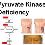 hemolytic anemia due to pyruvate kinase deficiency