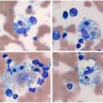 hemophagocytic lymphohistiocytosis