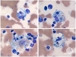 hemophagocytic lymphohistiocytosis