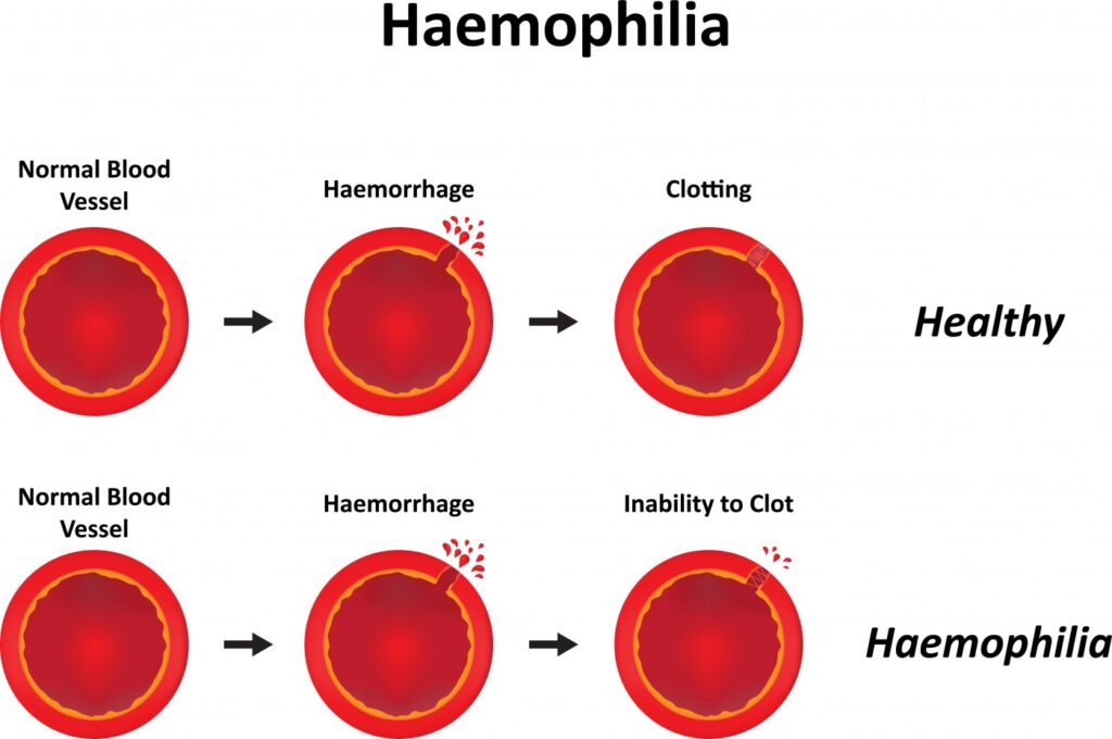 hemophilia a