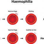 hemophilia a