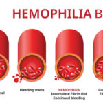 hemophilia b