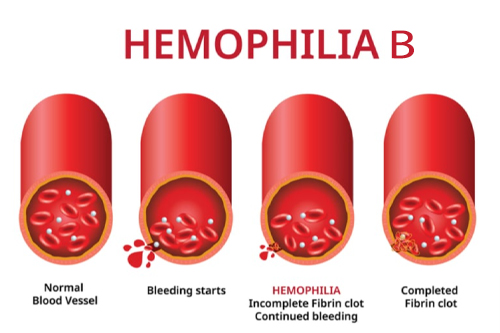 hemophilia b