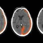 hemorrhaging in hemophilia