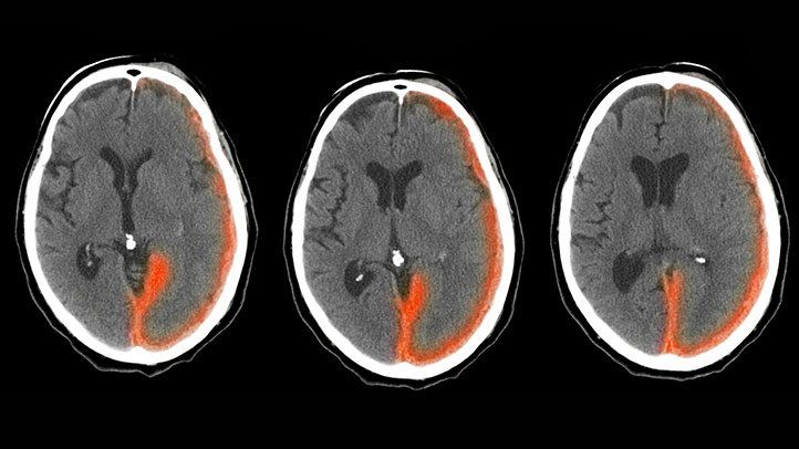 hemorrhaging in hemophilia