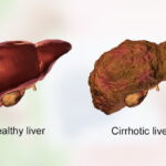 hepatic cirrhosis