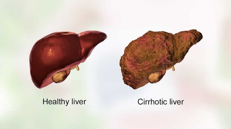 hepatic cirrhosis