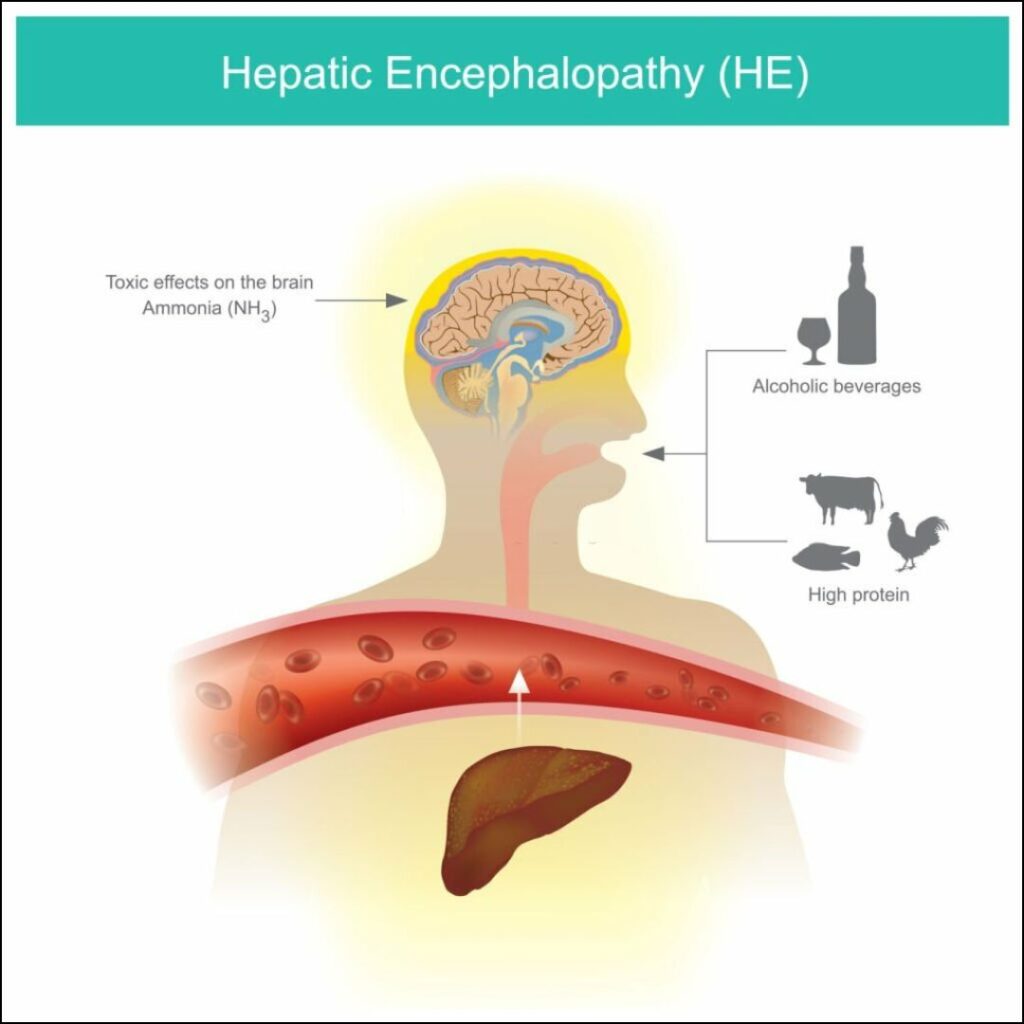 hepatic encephalopathy