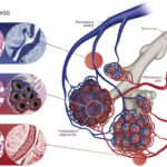 hepatic veno occlusive disease