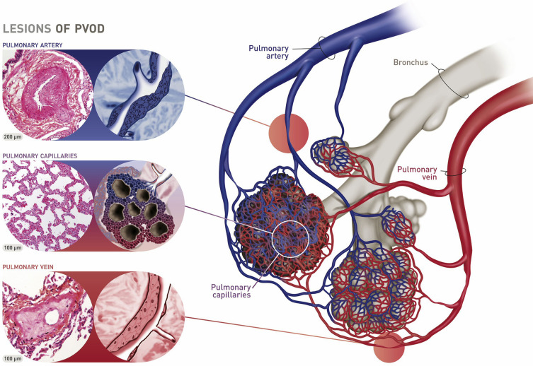 hepatic veno occlusive disease