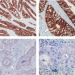 her2 positive adenocarcinoma of gastroesophageal junction