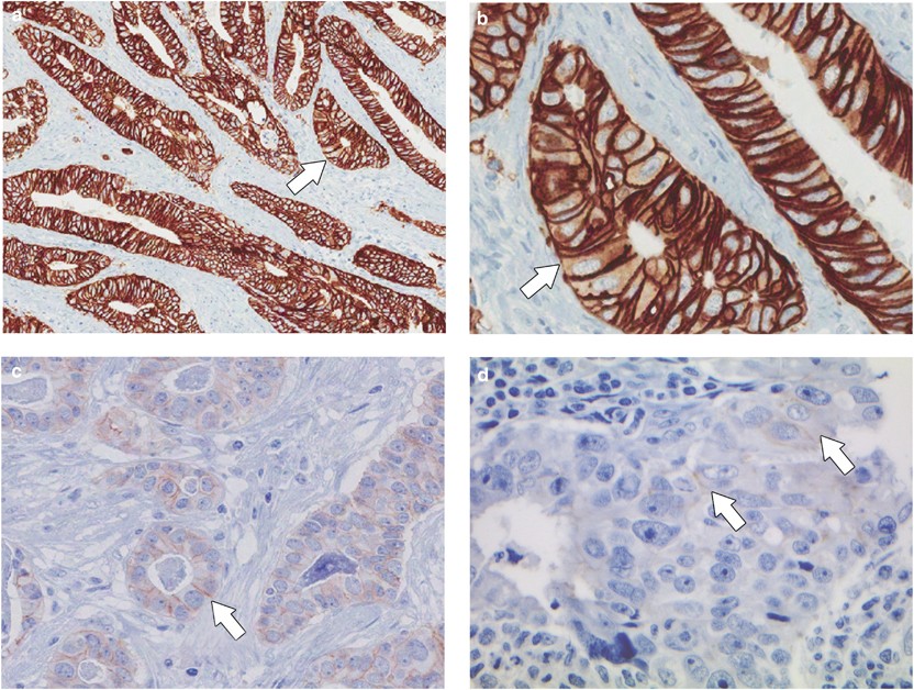 her2 positive adenocarcinoma of gastroesophageal junction