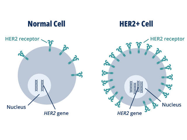 her2 positive colorectal cancer