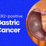 her2 positive gastric adenocarcinoma