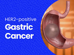 her2 positive gastric adenocarcinoma