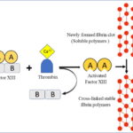 hereditary factor xiii a subunit deficiency