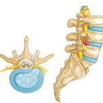 herniated lumbar disc