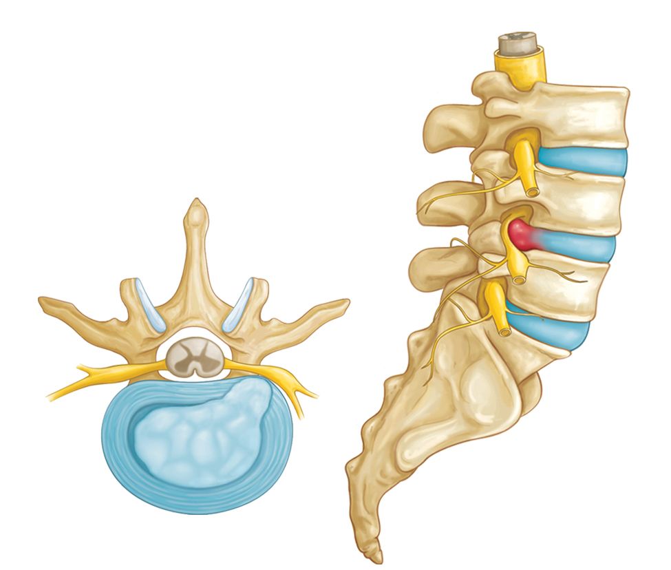 herniated lumbar disc