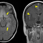 herpes simplex encephalitis