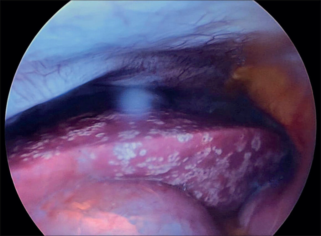 herpes simplex hepatitis