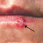 herpes simplex infection