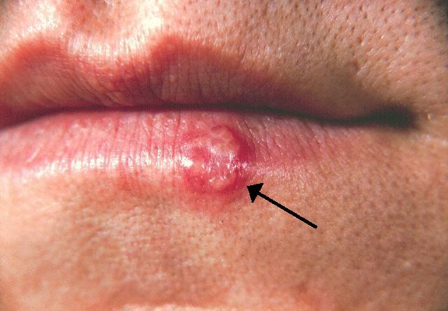 herpes simplex infection