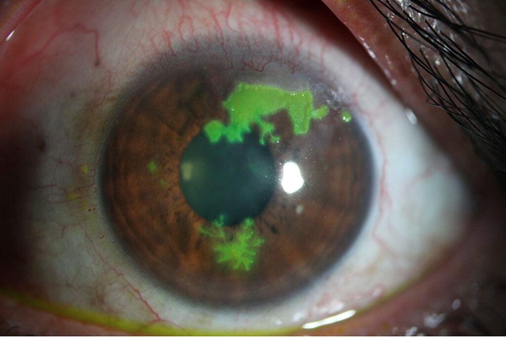 herpes simplex keratitis