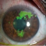 herpes simplex keratitis