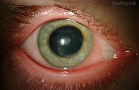 herpes simplex keratoconjunctivitis