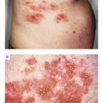 herpes zoster hepatitis