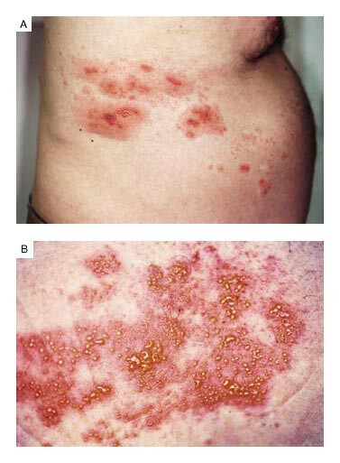 herpes zoster hepatitis