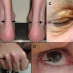 heterozygous familial hypercholesterolemia