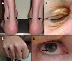 heterozygous familial hypercholesterolemia