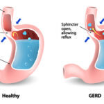 hiatal hernia with reflux esophagitis