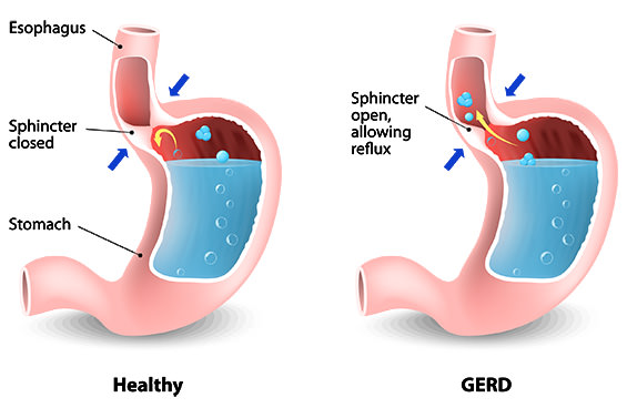 hiatal hernia with reflux esophagitis