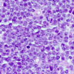 high grade b-cell lymphoma