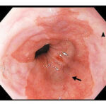 high grade dysplasia associated with barrett's esophagus