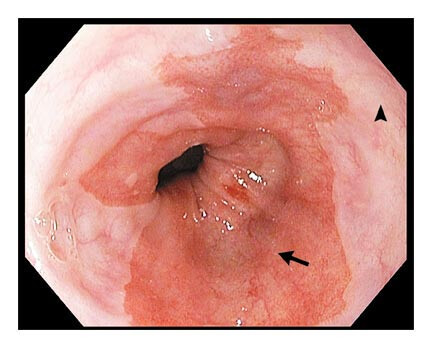 high grade dysplasia associated with barrett's esophagus