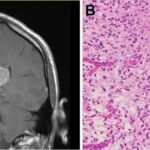 high grade glioma with braf v600e mutation