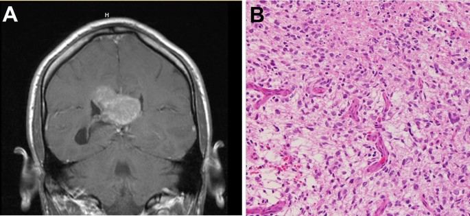 high grade glioma with braf v600e mutation