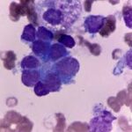 high risk neuroblastoma in bone or bone marrow